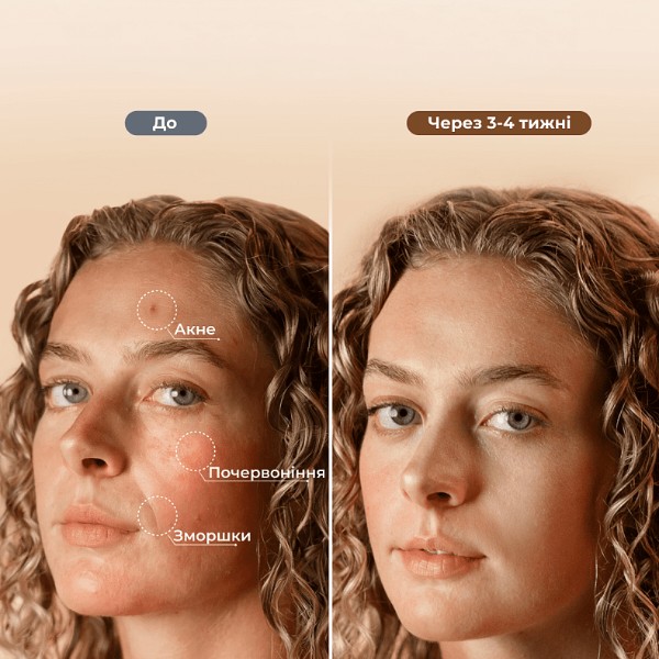 Фото - Led маска для обличчя RENPHO Artemis LED Light Therapy Mask (E100B-1-PK)